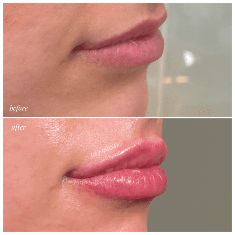 Lips 1