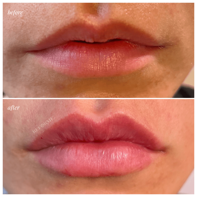 Lips 15