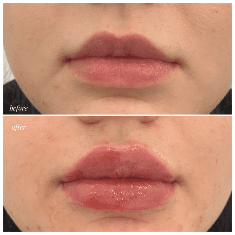 Lips 5