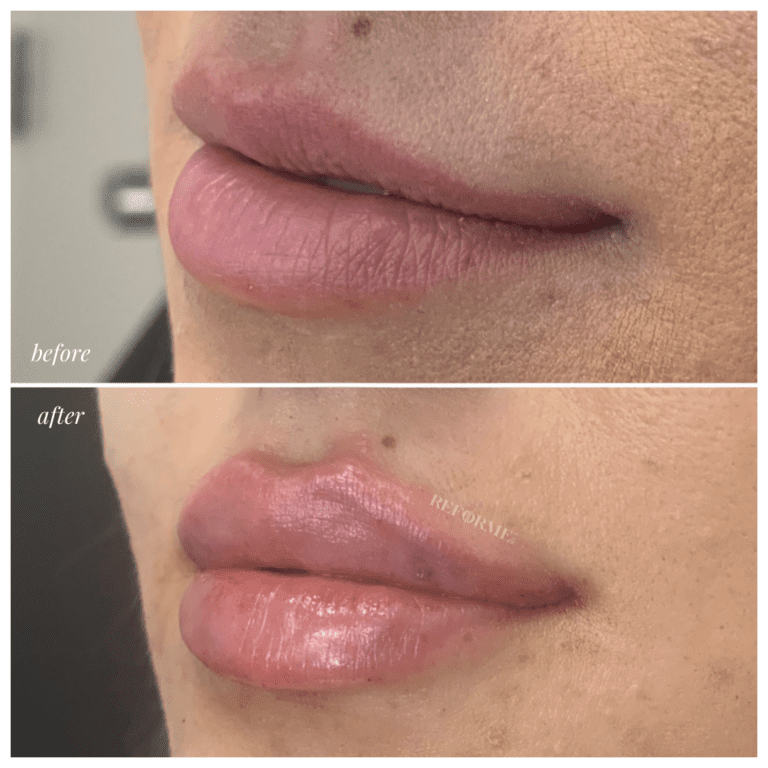 Lips 6