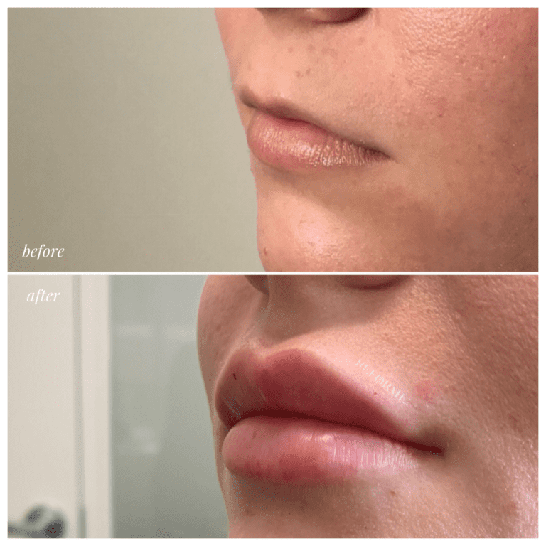 Lips 7