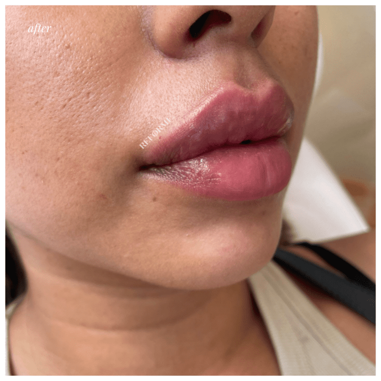 Lips 9