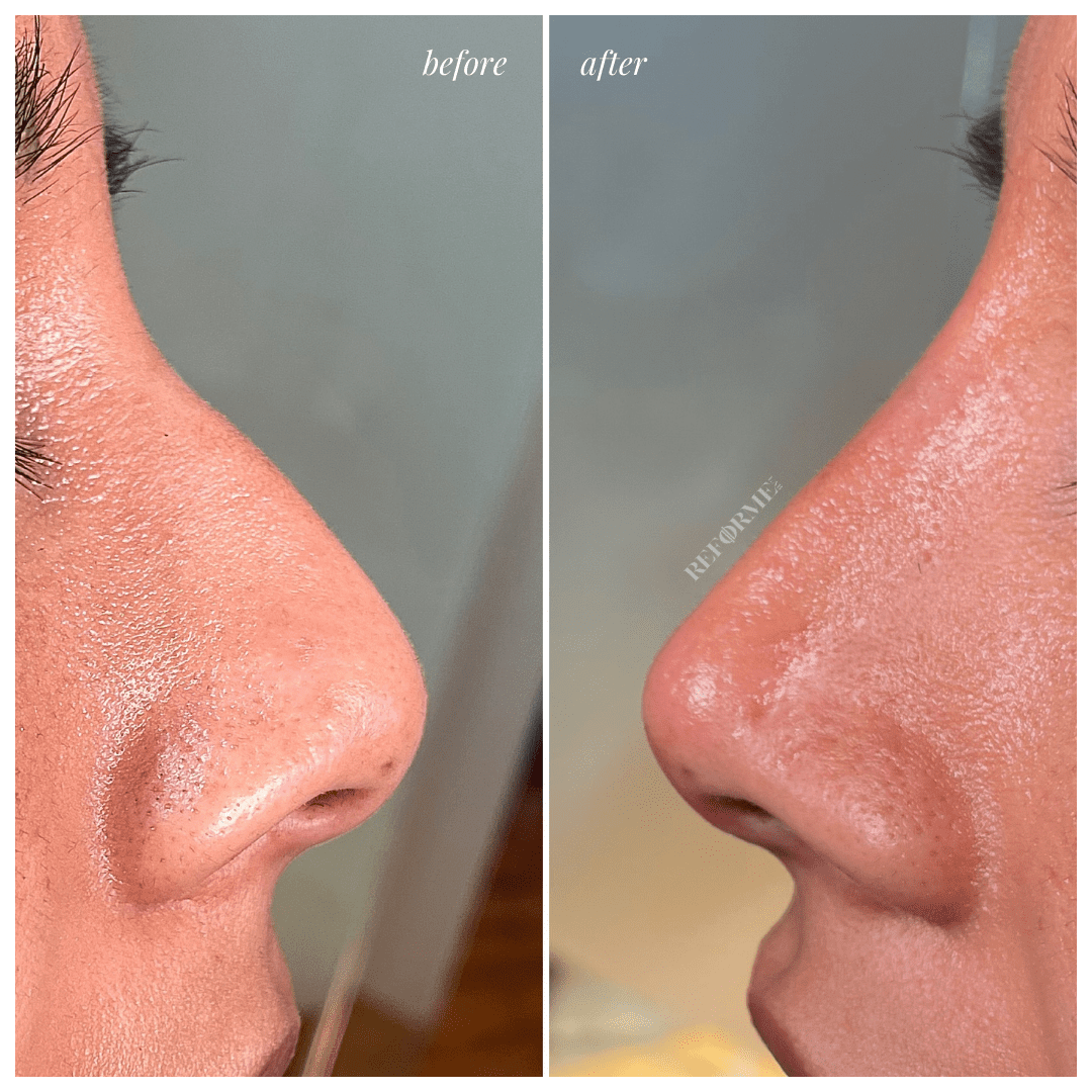Reforme Lab|Hollow Under Eye Skin Therapy
