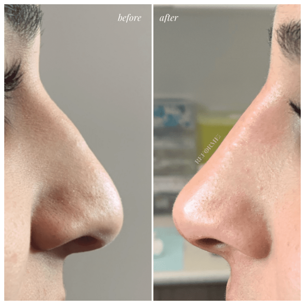 non-surgical nose job in Toronto and Mississauga