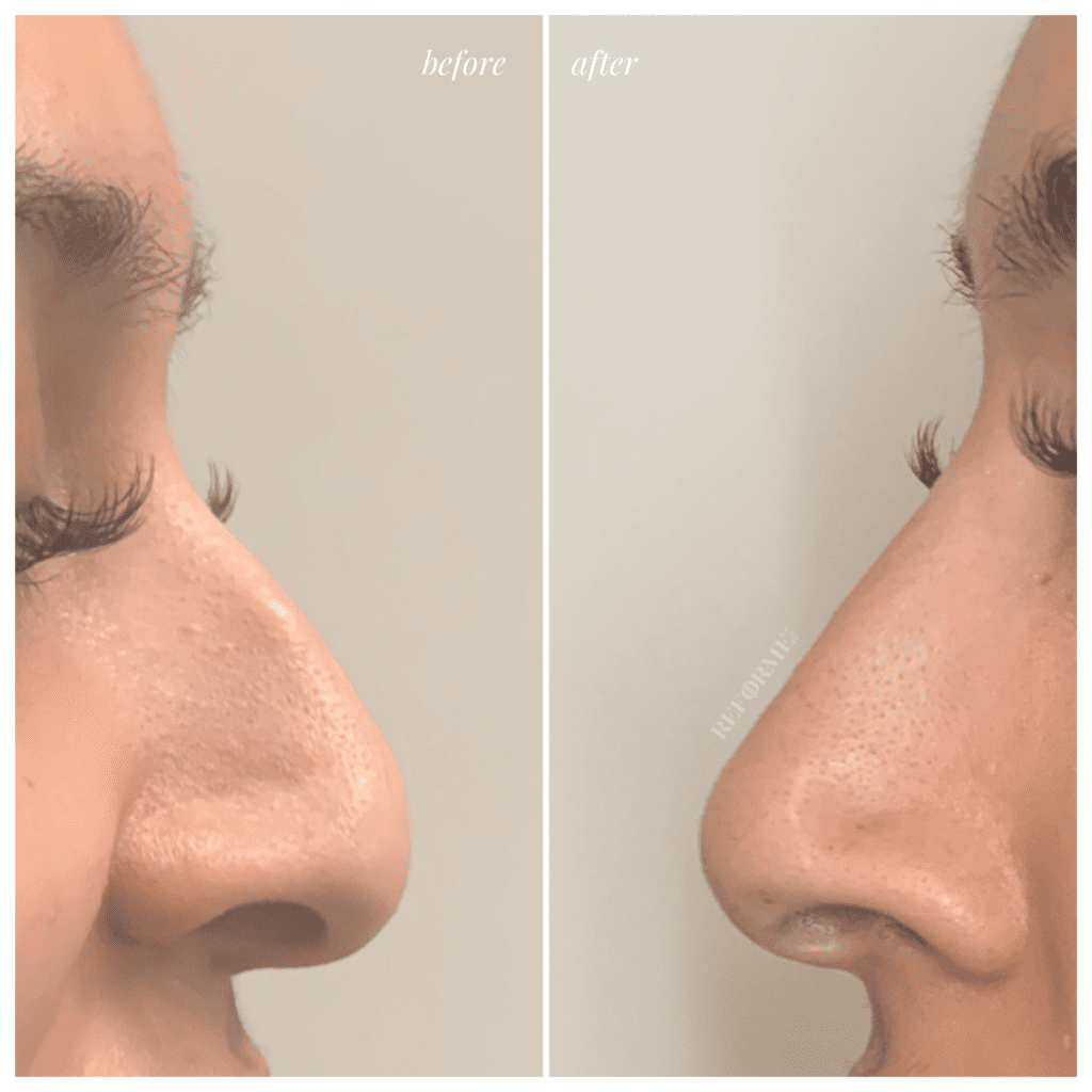 Reforme Lab|Non-Surgical Rhinoplasty  Landing Page