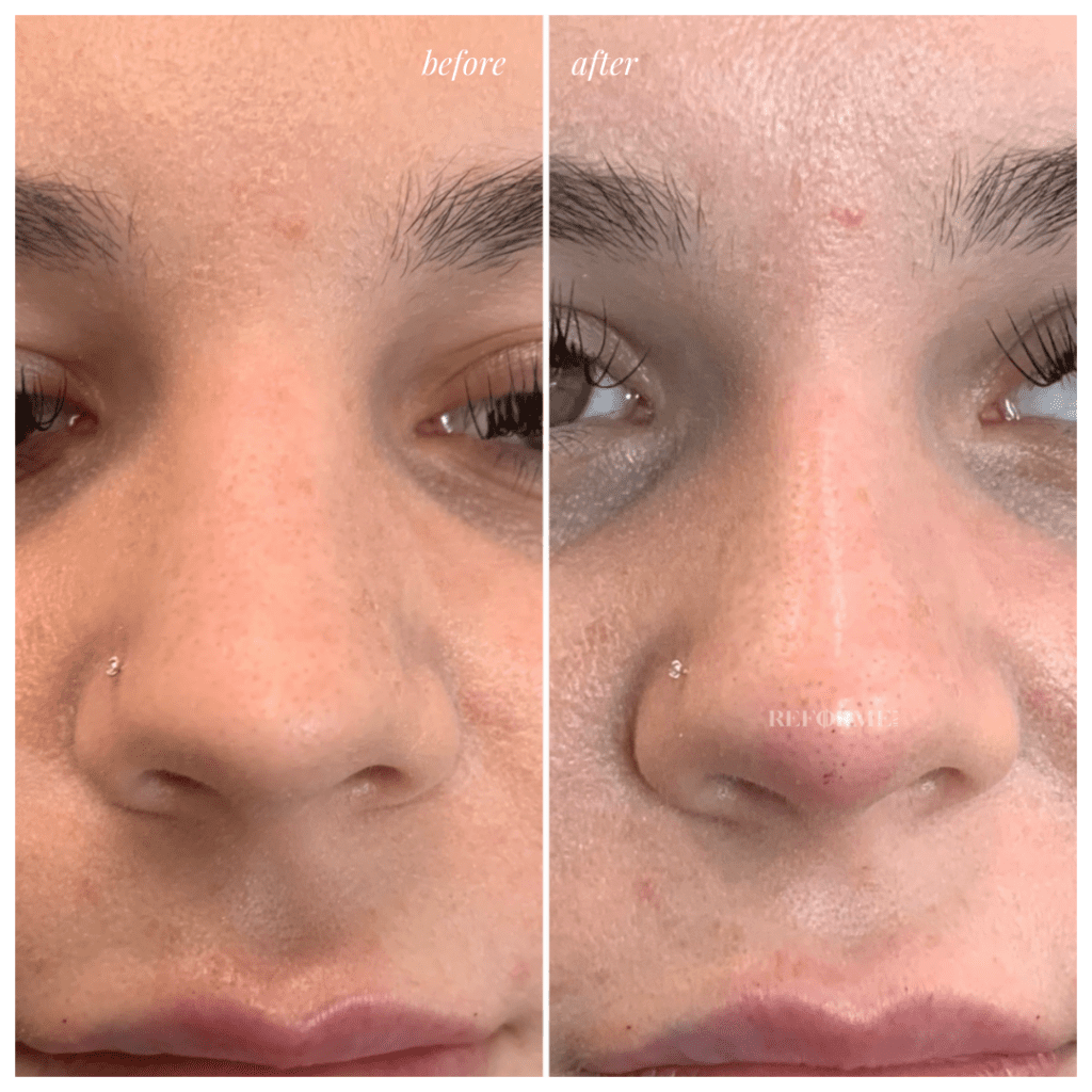 Non-Surgical Nose Job in Toronto and Mississauga