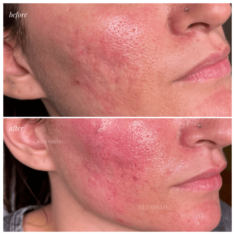Skin - Mesotherapy Acne Scaring