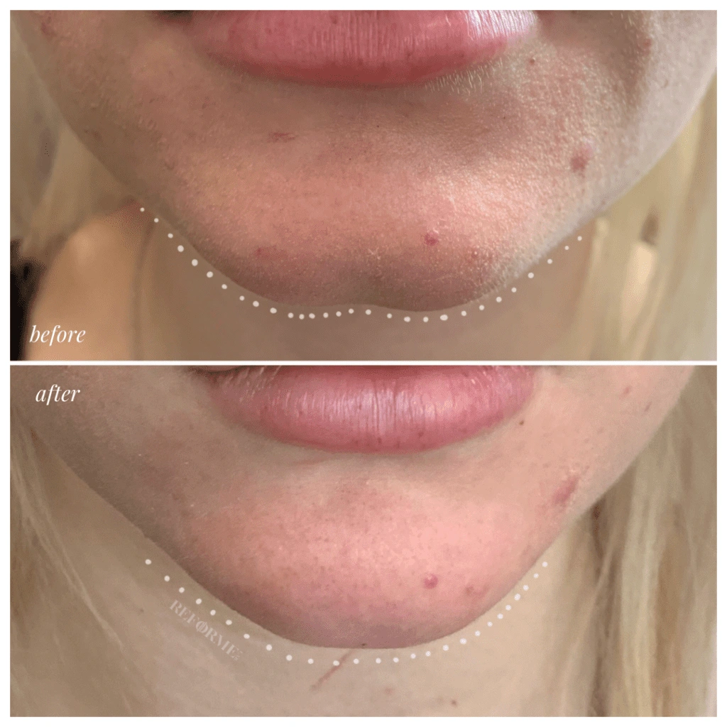 dermal fillers injectables chin results