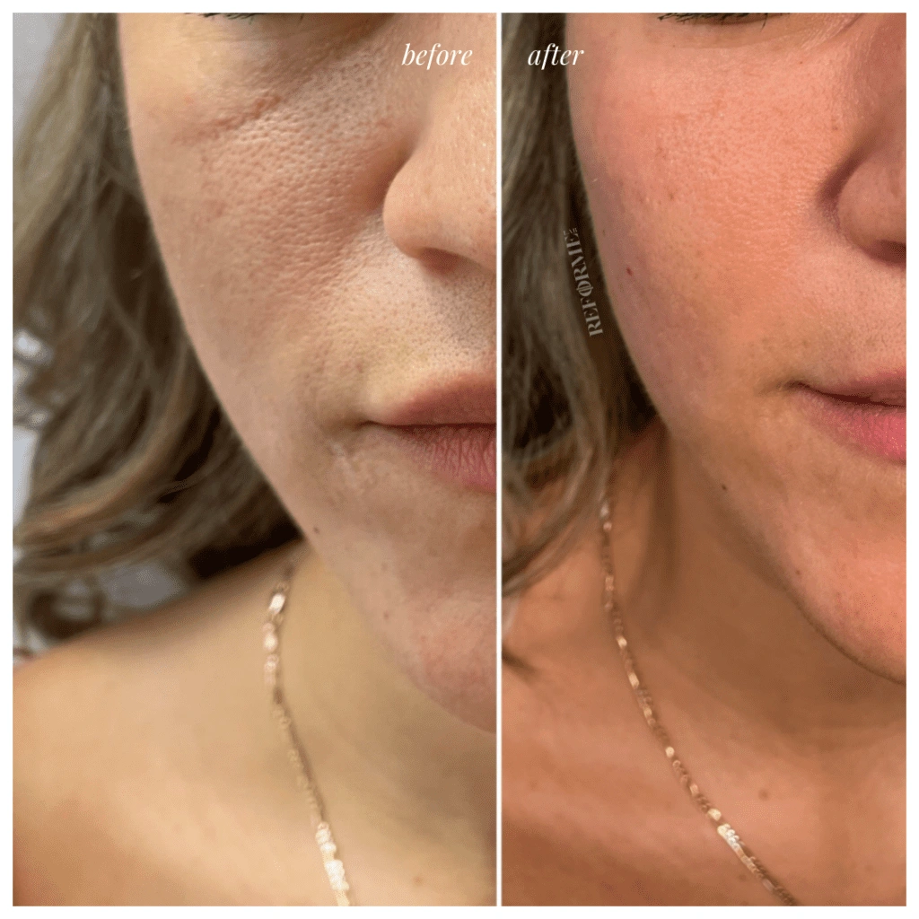 dermal fillers injectables face undereye results