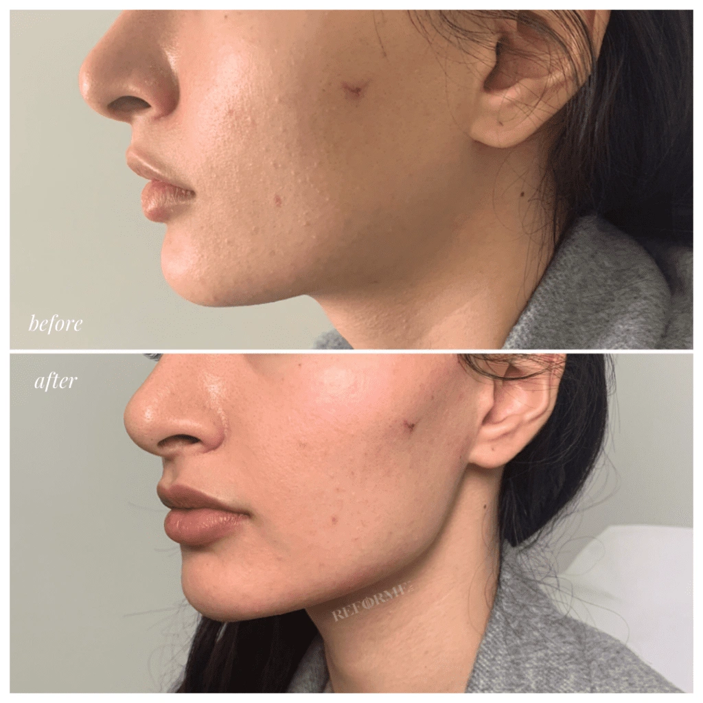 dermal fillers injectables lips chin extention jaw results