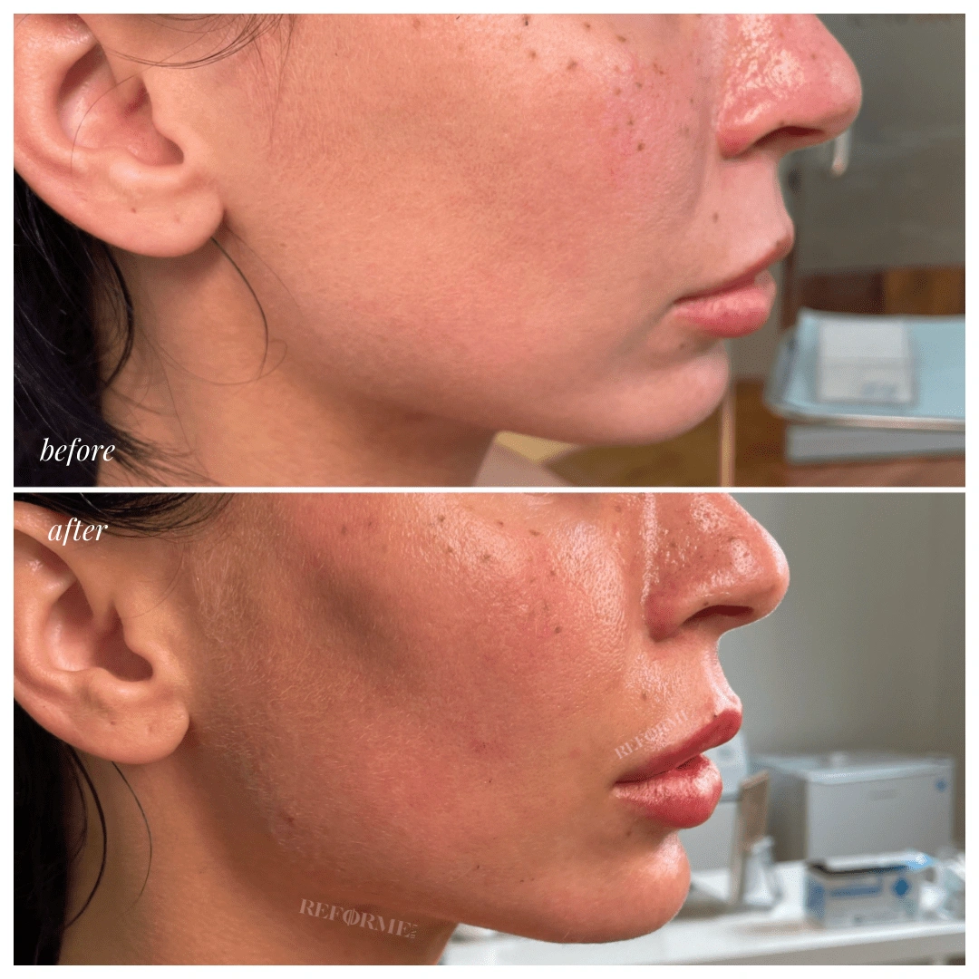 dermal fillers injectables restore volume dermal fillers mississauga