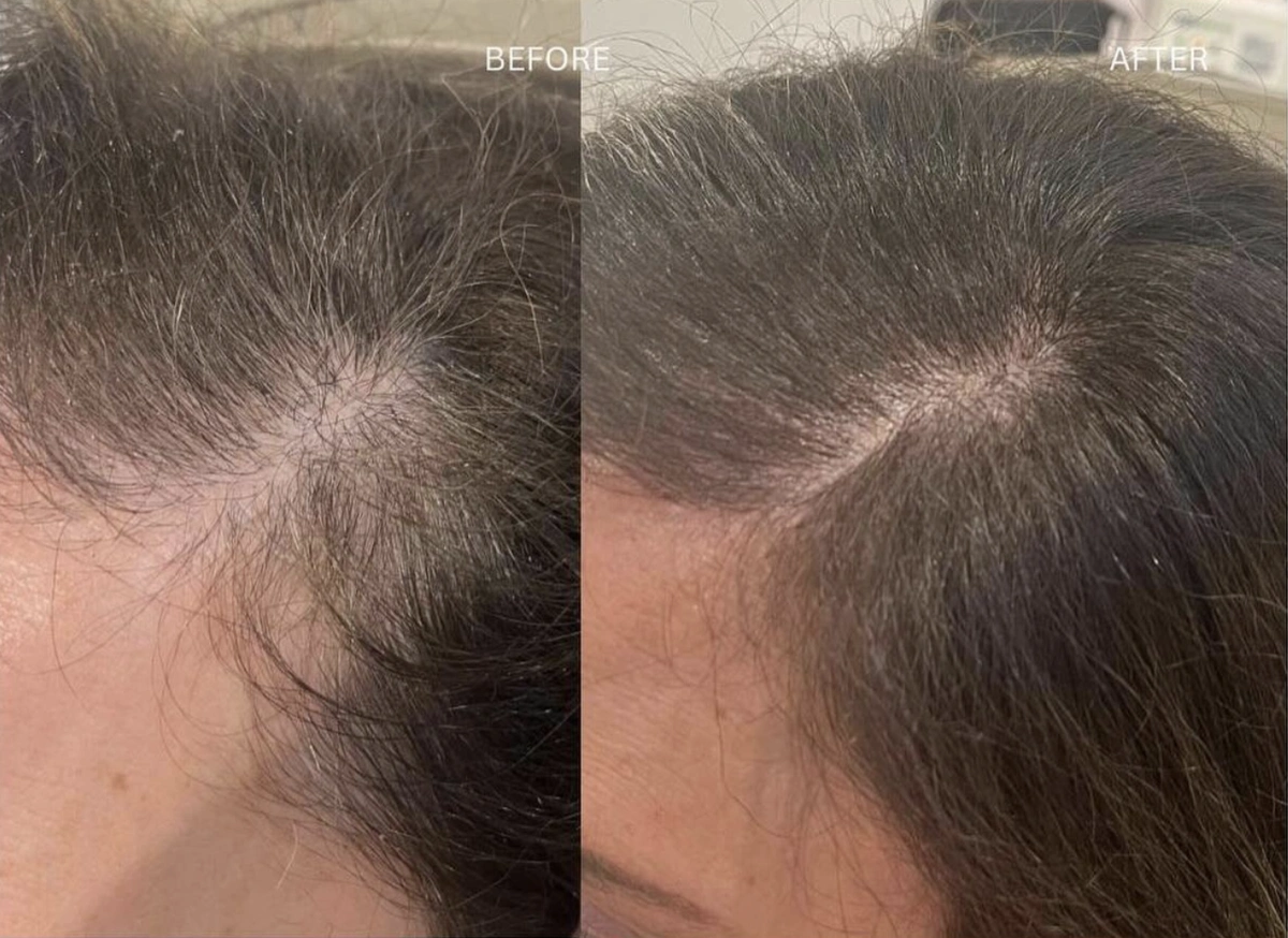 hair restoration treatments results