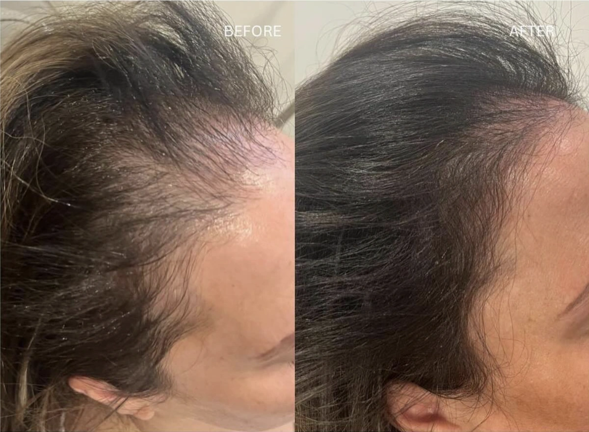 hair restoration treatments