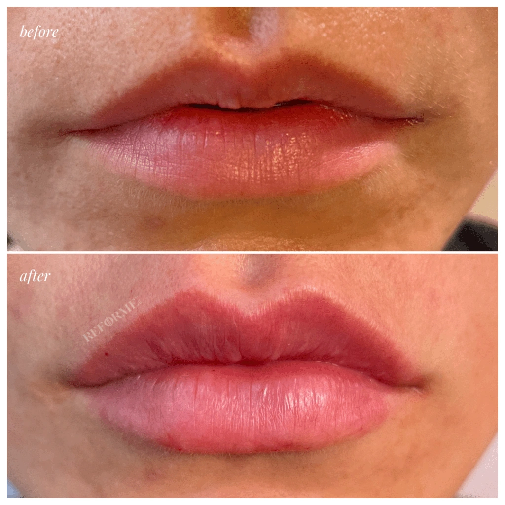 lip plump personalized lip treatments mississauga