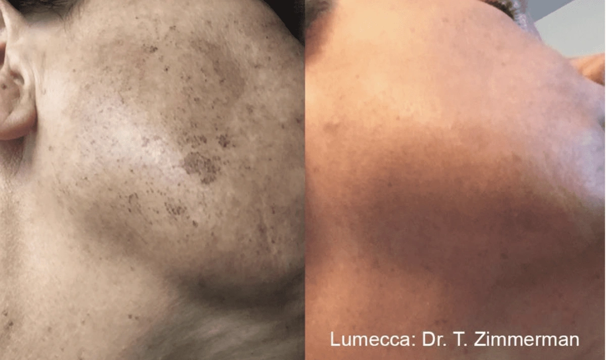 lumecca ipl facial skin care