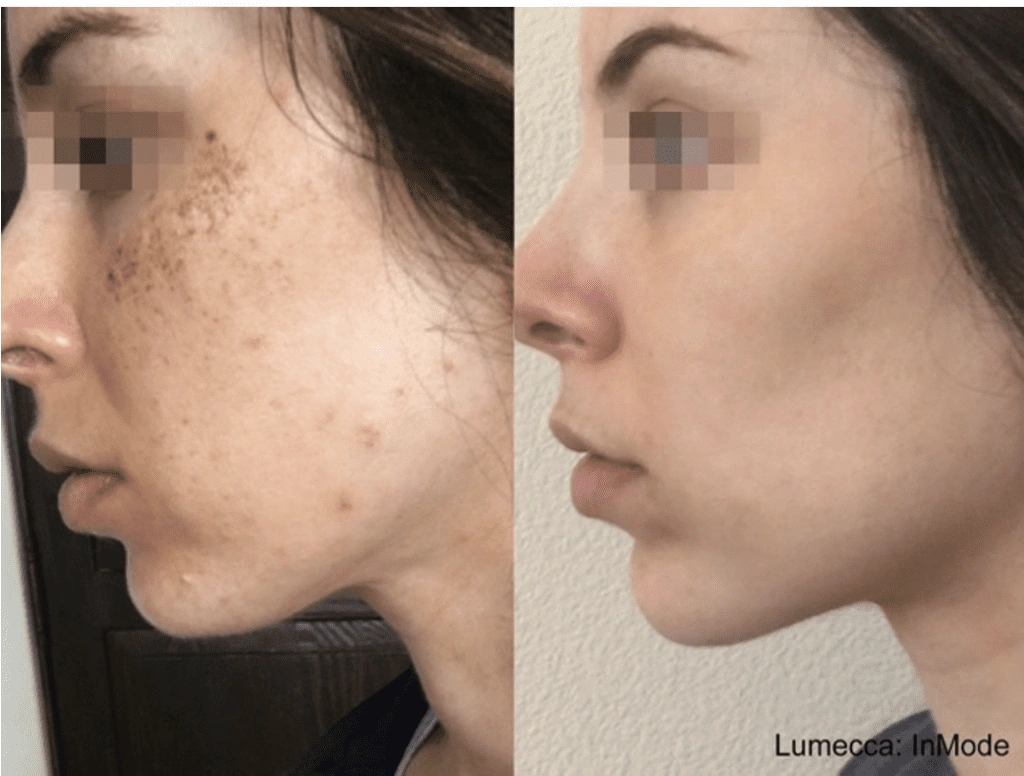 lumecca ipl skin care toronto