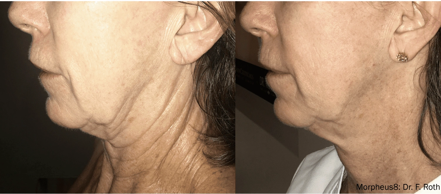 morpheus8 skin tightening mississauga