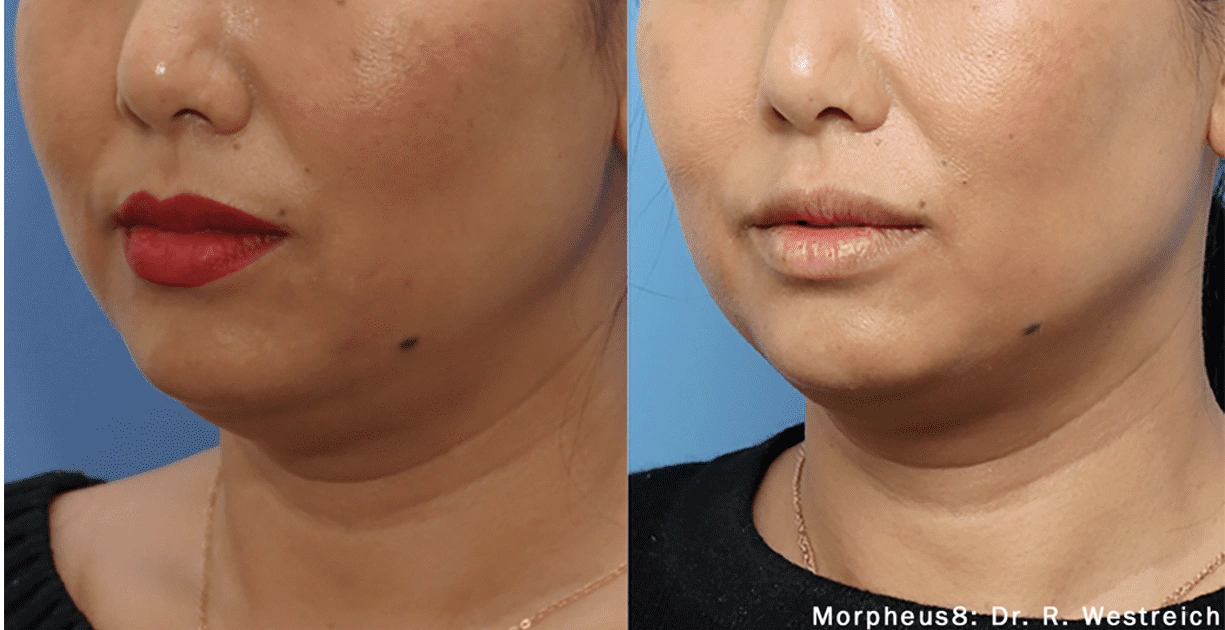 morpheus8 skin tightening toronto