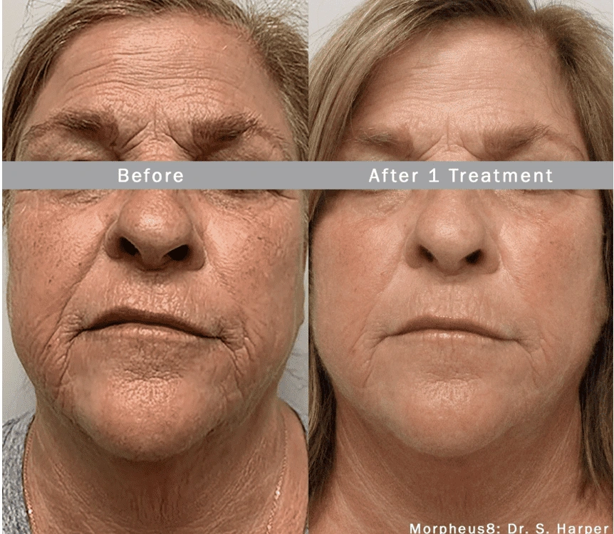 morpheus8 skin treatment