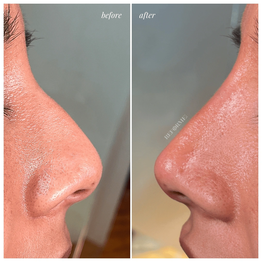 reforme lab medical spa limited time promotion non surgical rhinoplasty
