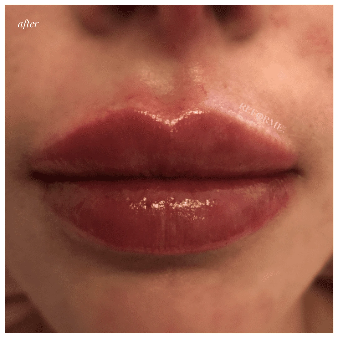 reforme lab medical spa lip filler treatments