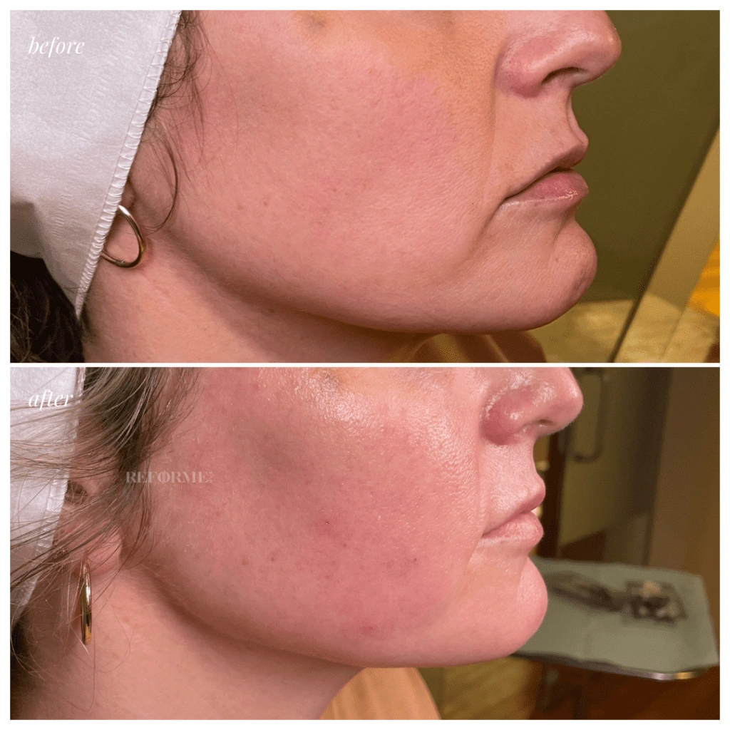 reforme lab medical spa skin rejuvination fine lines and veins