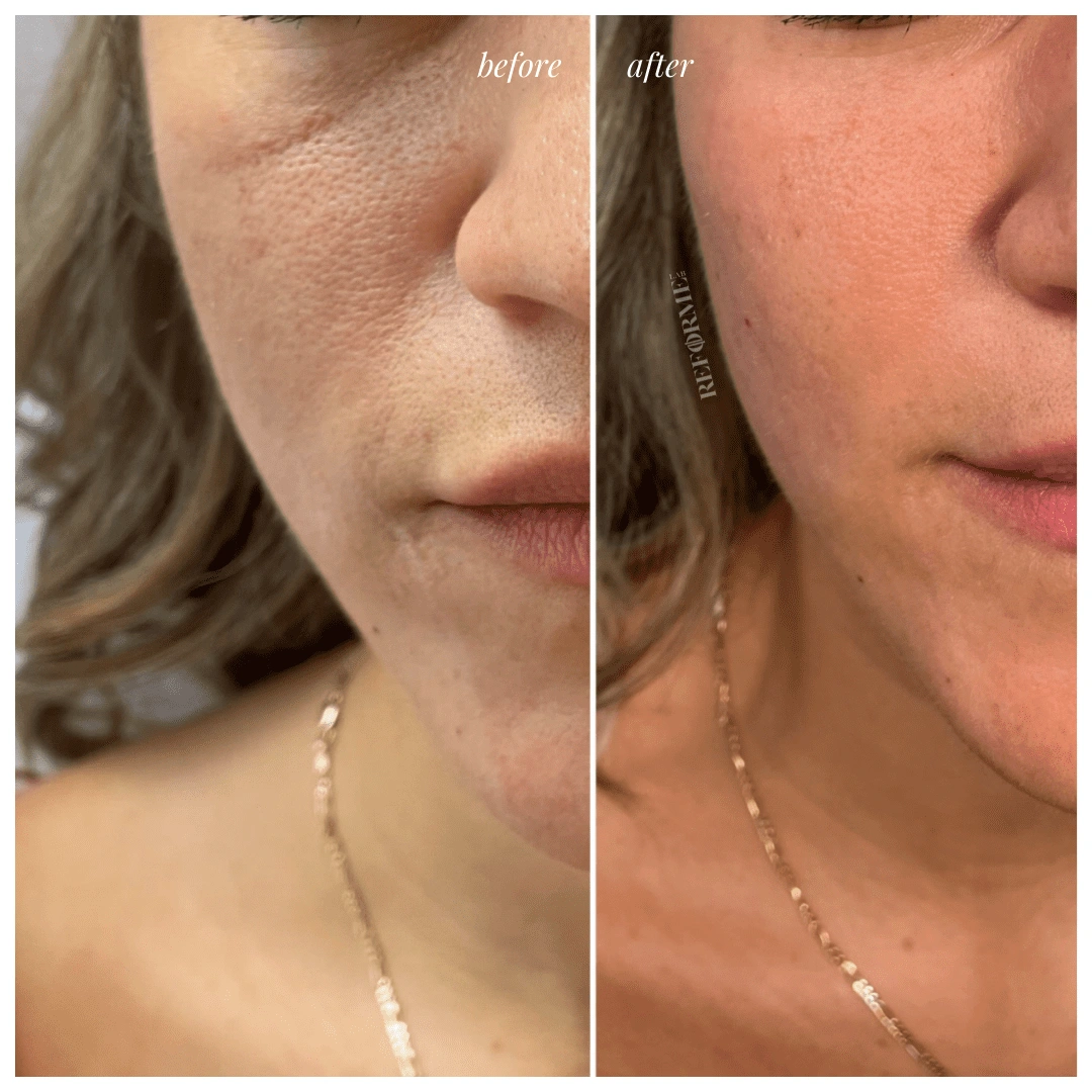under eye filler treatment revitalize look toronto