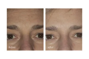 co2 treatments toronto