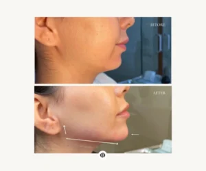 facial restructuring burlington
