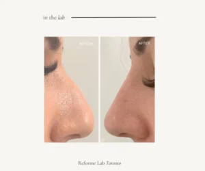 facial restructuring markham