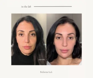 facial restructuring vaughan