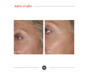 facial treatment Ajax