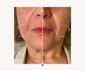 facial treatment burlington