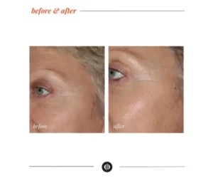 facial treatments brampton