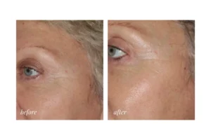 fractional resurfacing gta