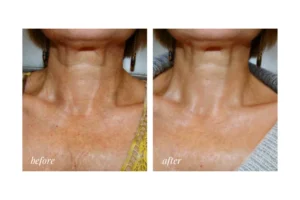 fractional resurfacing near me