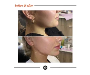 jaw shaping Ajax