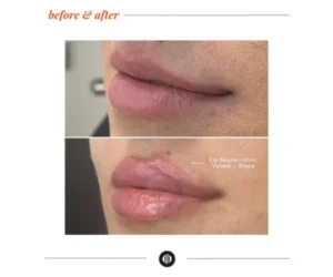 lip filler brampton