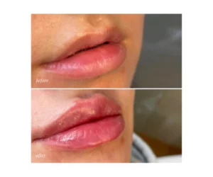 lip filler burlington
