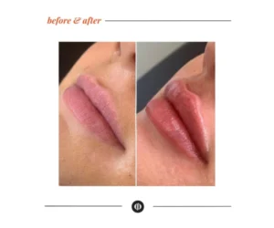 lip filler in Ajax