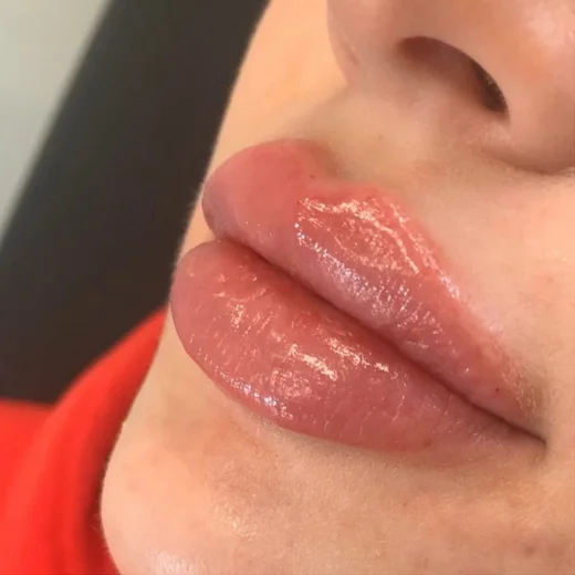 lip filler services gta