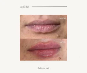 lip filler vaughan