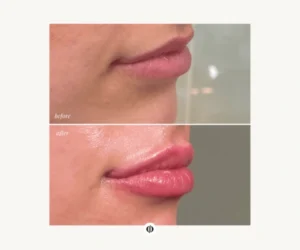 lip plumping service pickering