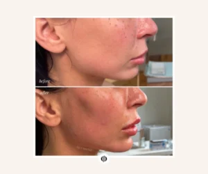 lip plumping services pickering