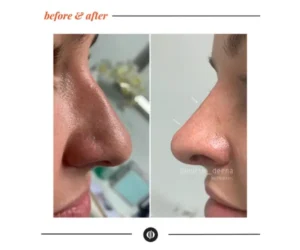 non surgical nose job brampton