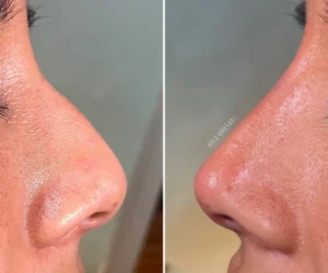 non surgical nose job etobicoke