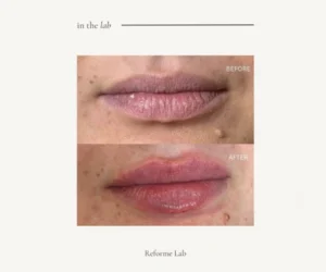 pickering lip plump treatment