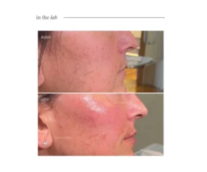 skincare treatment markham