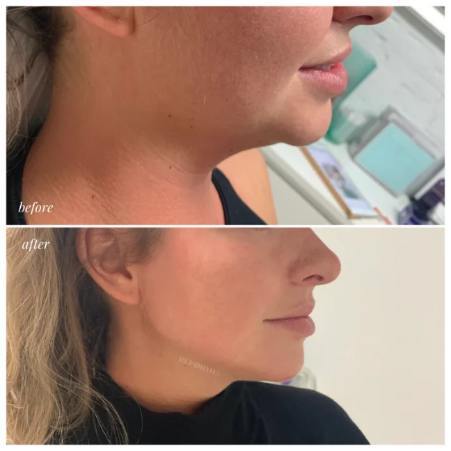 dermal fillers toronto mississauga