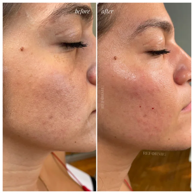 hyaluronic acid face injection